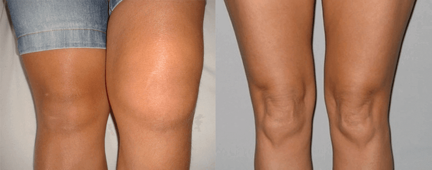 Εμπειρία χρήσης των καψουλών Cannabis Oil πριν και μετά τη χρήση από την Eva